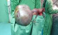 Removing a "5 kg tumor" from a patient's stomach in Gerash Hospital